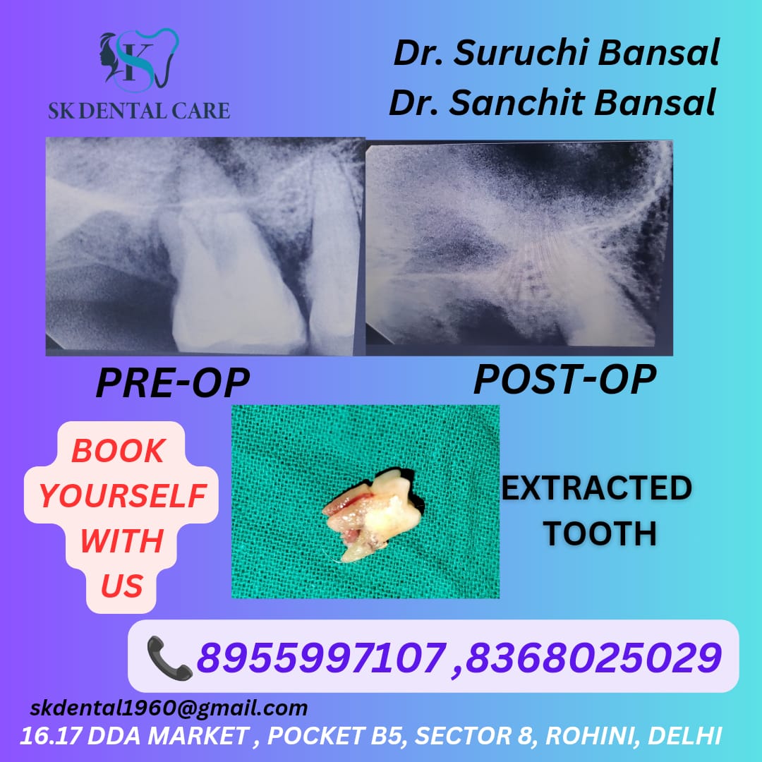 Tooth Extraction